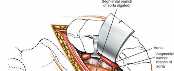 Illustration 21 for Master the Anterolateral Retroperitoneal Approach to Lumbar Spine