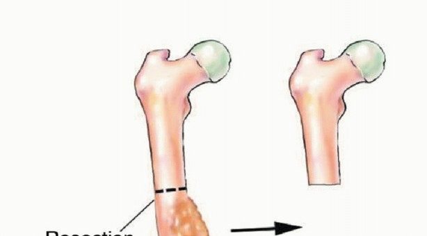 Illustration 12 for Free Vascularized Fibular Grafts: Solving Complex Bone Defects