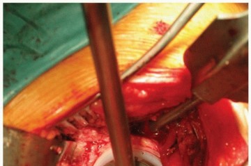 Illustration 11 for Cemented Acetabular Component: Achieving Optimal THA Stability