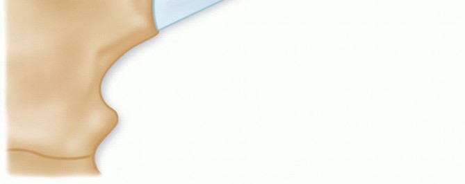 Illustration 30 for Optimizing SC Dislocation Repair After Medial Clavicle Resection