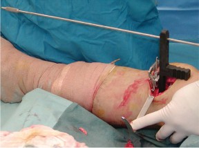 صورة طبية: جراحة استبدال مفصل الركبة الجزئي (UKA): تجنب الأخطاء والاستفادة القصوى في صنعاء مع الأستاذ الدكتور محمد هطيف