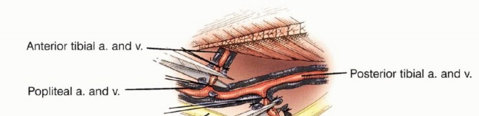 Illustration 23 for Tackling Complex Tumors of the Proximal Tibia: Limb-Sparing Solutions