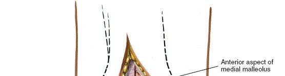 Illustration 22 for Optimized Approaches to the Dorsum of the Foot & Ankle