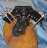 Illustration 8 for Conquering Adolescent Blount's Disease: A Surgical Guide