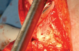 Illustration 82 for Femoral Stem Revision: Posterior Approach for Better Outcomes