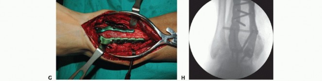 Illustration 30 for Optimize Pain Management with Proximal Ring Block for Ankle Arthrodesis