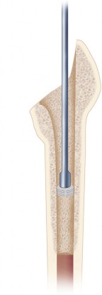 Illustration 14 for Cemented Femoral Stem Figures: Surgical Anatomy & Placement