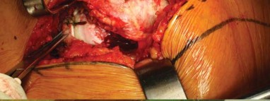 Illustration 65 for Successful Total Hip Replacement in Developmental Dysplasia