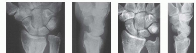 Illustration 2 for Precision Correction for Distal Radius Malunion