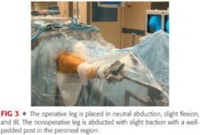 Illustration 105 for Mastering the Scope for Femoroacetabular Impingement