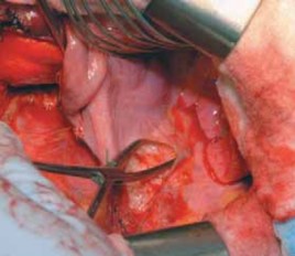 Illustration 38 for Mastering Anterior Interbody Arthrodesis with Instrumentation for Scoliosis