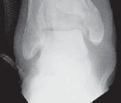 Illustration 15 for Optimizing ORIF for Tibial Plafond Fractures: A Modern Approach