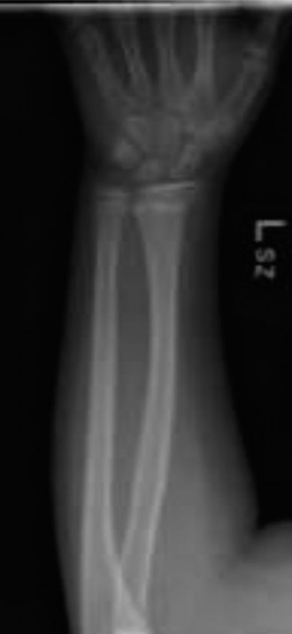 Illustration 3 for Pediatric Buckle Fracture: When is a Velcro Wrist Brace Best?