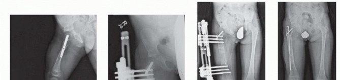 Illustration 31 for Treatment for Congenital Femoral Deficiency: What You Need to Know