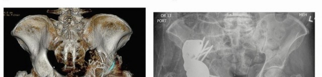 Illustration 14 for Mastering Revision THA: Strategies for Adverse Local Tissue Challenges