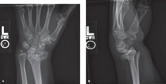 Radius Fracture Distal: Prevent CRPS & Uncover Instability Signs