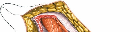 Illustration 44 for Unlocking Every Aspect of the Hip's Surgical Approaches