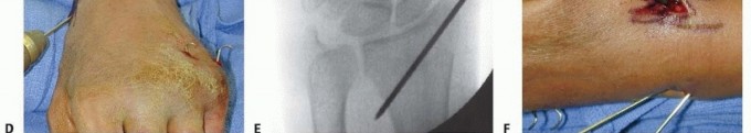 Illustration 16 for Effective K-Wire Fixation: Distal Radius Fractures Without External Fixation