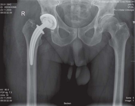 Illustration 73 for Collum Femoris Preserving: Achieve Better Primary Hip Outcomes