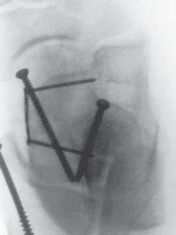 Illustration 29 for Talar Neck Fracture Treatment: Optimizing Recovery with ORIF