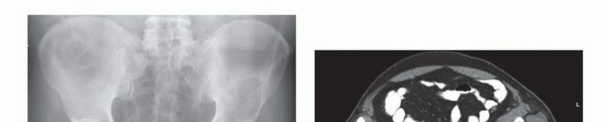 Illustration 7 for Pelvic Metastasis Surgery: A Component of the Utilitarian Approach