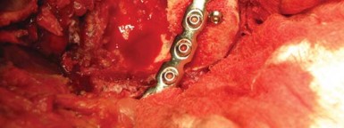 Illustration 30 for Navigating Early THA for Fractures of the Acetabulum