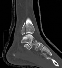 Illustration 4 for Partial Articular Fractureplate Fixation: Restore Anatomy