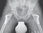Illustration 34 for Increased Femoral Anteversion: A Proximal Femoral Rotational Osteotomy
