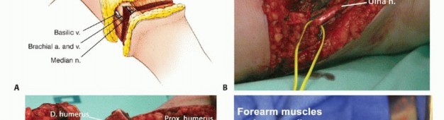 Illustration 17 for Above-Elbow & Below-Elbow Amputations: When & Why They're Needed