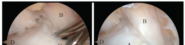 Illustration 21 for Posterior Talar Process: Endoscopic Solutions for Ankle Pain