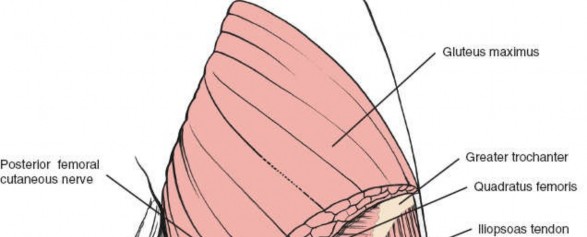 Illustration 120 for Optimal Femoral Approaches: Mastering the Lateral Intermuscular Septum