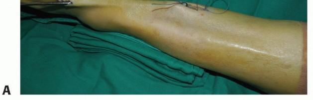 Illustration 35 for Restore Movement: Tendon Transfer for Common Peroneal Nerve Foot Drop