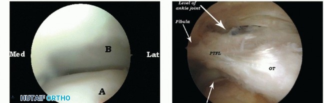 Illustration 12 for Posterior Talar Process: Endoscopic Solutions for Ankle Pain