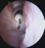 Illustration 26 for Capsular Releases for Loss of Motion: Restore Your Shoulder