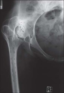 Illustration 117 for Successful Total Hip Replacement in Developmental Dysplasia