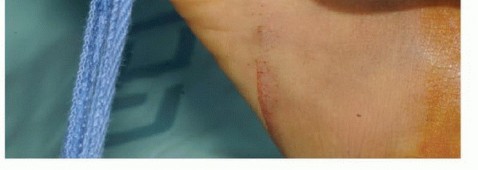 Illustration 22 for Avoid Major Surgery: Bone Tumor Treatment with Liquid Nitrogen Pour