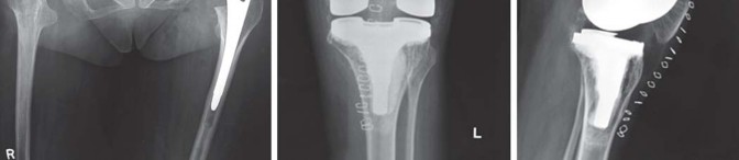 Illustration 46 for Total Hip Arthroplasty: Restoring Mobility in Juvenile Idiopathic Arthritis