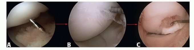 How is Arthroscopic Drilling and Fixation for Knee OCD Performed?