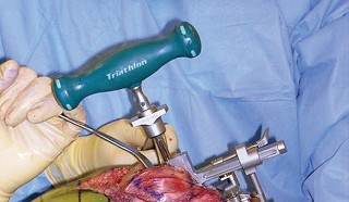 Illustration 16 for Optimize Tibial Component Alignment: Techniques for TKA Success