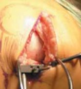 Illustration 9 for Knee Arthroplasty Unicondylar: Discover if Partial Knee Replacement is Right