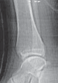 Illustration 22 for Pediatric Ankle Fractures: Management to Prevent Long-Term Issues