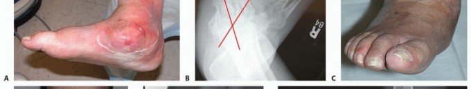 Illustration 10 for Regain Mobility: Surgical Solutions for Charcot Foot Arthropathy