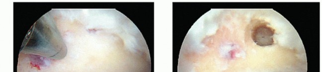 Illustration 15 for Posterior Talar Process: Endoscopic Solutions for Ankle Pain
