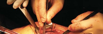 Illustration 12 for Metal on Metal Resurfacing: Enhanced Posterior Soft Tissue Repair