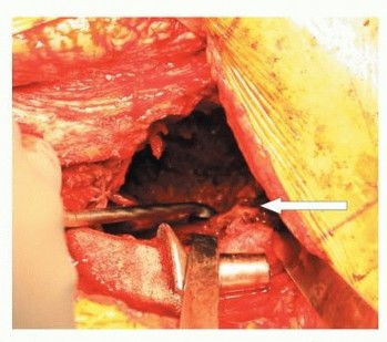Illustration 9 for Revision Arthroplasty with Acetabular Bone Loss: The Antiprotrusio Cage