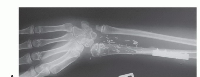 Illustration 41 for Free Vascularized Fibular Grafts: Solving Complex Bone Defects