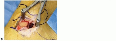 Illustration 60 for Medial Ankle Instability: Find Relief with Reconstruction