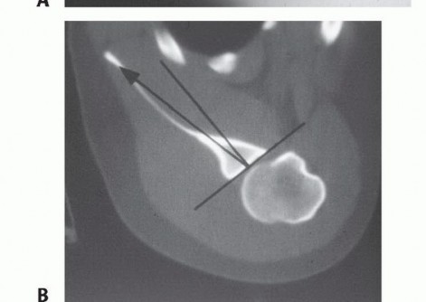 Illustration 3 for Mastering the Treatment of Recurrent Posterior Shoulder Instability