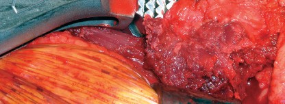 Illustration 27 for Cementless Femoral Stems: Master Indications & Avoid Pitfalls