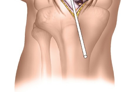Illustration 84 for Optimal Femoral Approaches: Mastering the Lateral Intermuscular Septum